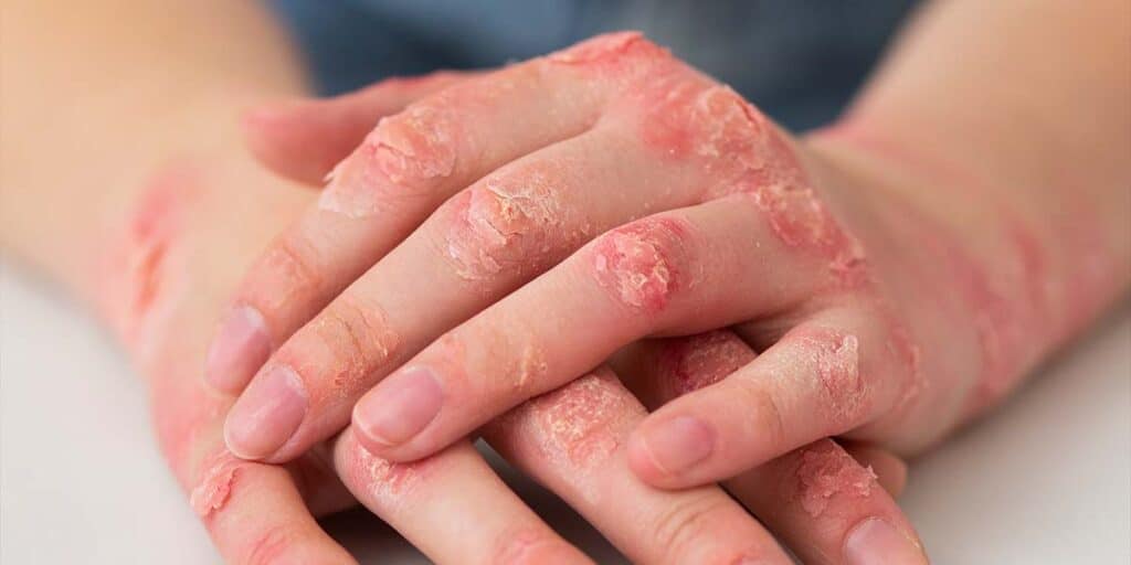 Artrite Psoriática: O que é e como tratar